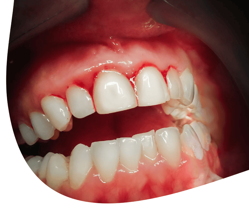 Detailní záběr na krvácející dásně a zuby, možné příznaky parodontitidy.